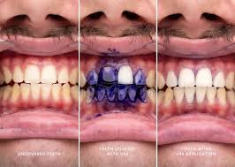 Blanqueador Dental HISMILE V34