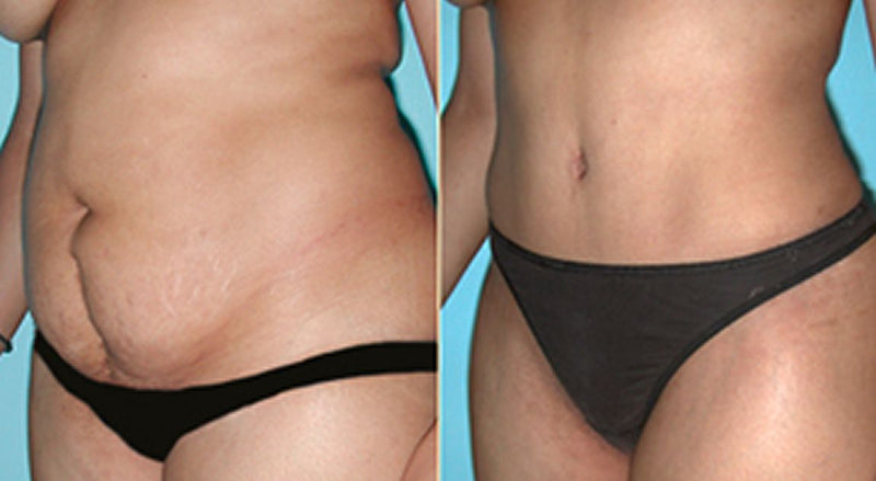¡QUEDAN MENOS DE 10 PRODUCTOS! | 🔥 Cuida tu piel y realza tu silueta con cada aplicación, LipoGel Plus🔥